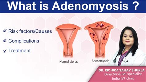 What Is Adenomyosis Treatments Symptoms And Causes Dr Richika Sahay