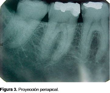 Osteonecrosis Mandibular Asociada A Bifosfonatos Presentaci N De Caso