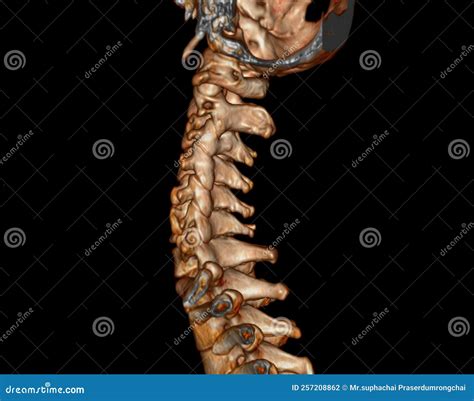 Cervical Fracture And Human Spine And Vertebrae Damage Outline Diagram