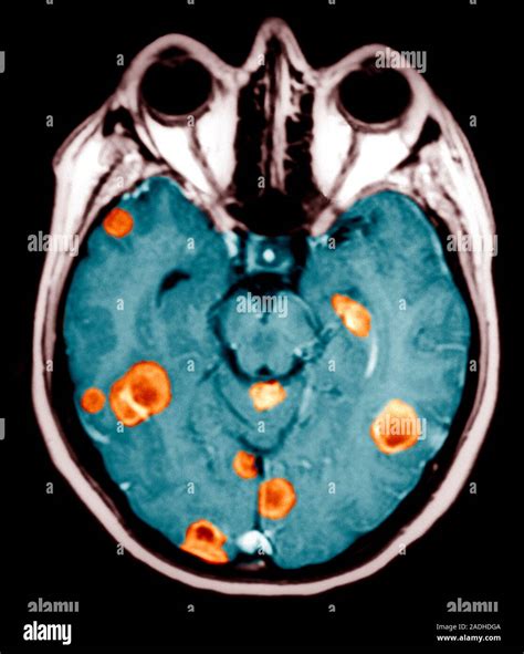 Le Cancer Du Cerveau Axial De Couleur Horizontale De L Imagerie Par