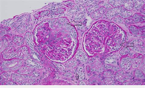 Kidney Biopsy Periodic Acid Schiff Stain Showing Two Glomeruli With