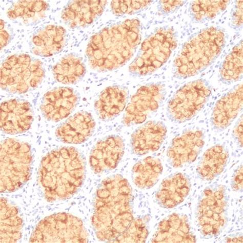 Cancer Diagnostic Antibody And Protein Pathological Diagnostic Reagent