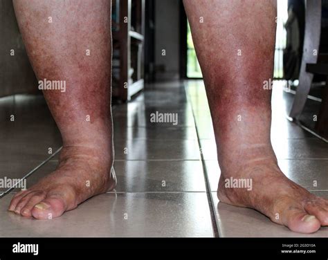 Leg Suffering From Chronic Venous Insufficiency With Mild Cellulitis In