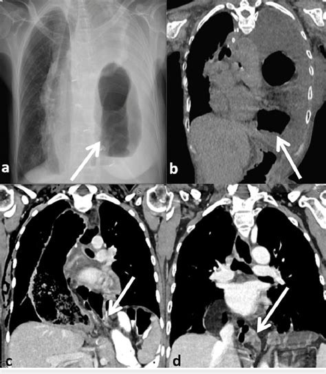 A And B Chest X Ray And Coronal View Of Hrct Chest Of Case