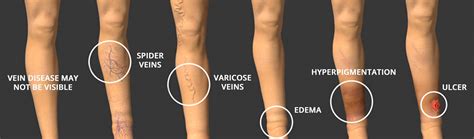 What Is Vein Disease Vein Specialists Kansas City