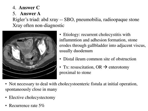 Ppt 1 Answer B Gastric Ulcer Classification I 50 Bodyantrum Of Stomach Along Lesser