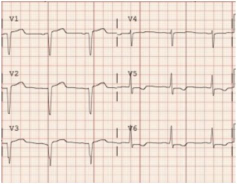 Benign Early Repolarization Vs Anterior Stemi County Em