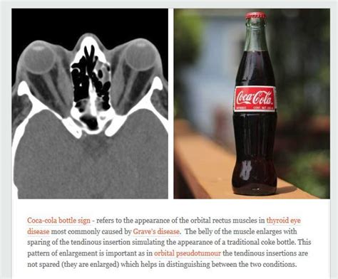 The Coca Cola Bottle Sign Refers To The Appearance Of The Muscles Of The Orbit In Thyroid Eye