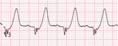 ECG FAQs | Get The Gas