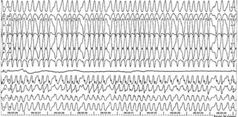 Atrial Fibrillation In The Wolff Parkinson White Syndrome Download