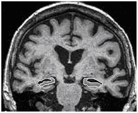 Example Of Manual Anatomical Delineation Of The Hippocampus White Line