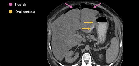 Abdominal Ct Peptic Ulcer Perforation • Litfl • Radiology Library