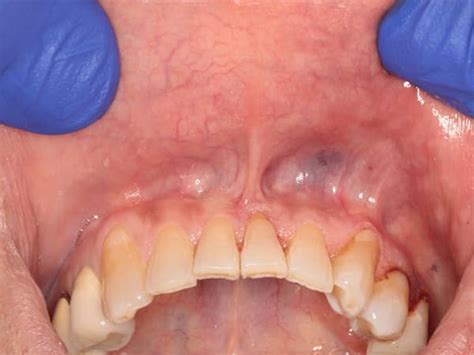 What Is A Frenectomy And How Much Is Frenulum Surgery