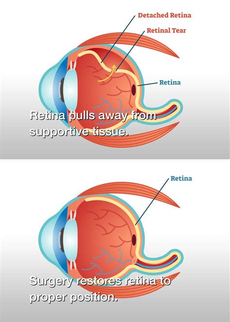 Detached Retina Surgery