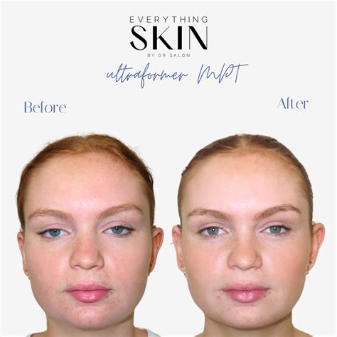 ultraformer mpt  skin tightening perth skincare  skin