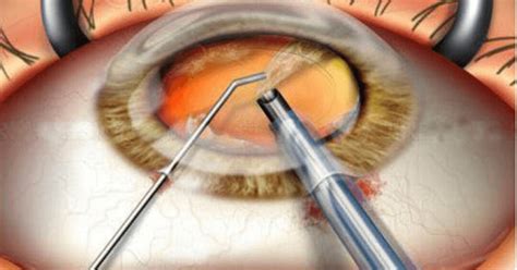 Cataract Surgery Cost in Mumbai | Affordable Motiyabind Operation