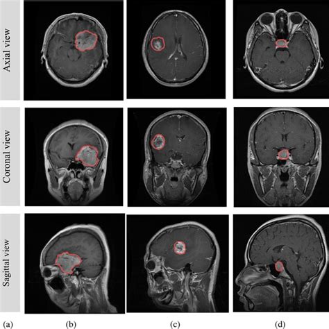 The three types of brain tumor with different views, where a capturing... | Download Scientific ...