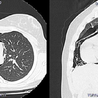 CT Scan of the chest. Pneumomediastinum and pneumopericardium ...