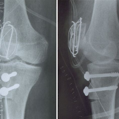 Multiple sagittal MRI views showing the complete patellar tendon ...