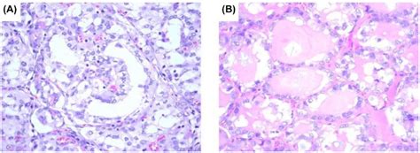 Microscopic Images Showing Histological Details Two Ptcs A C Ptc