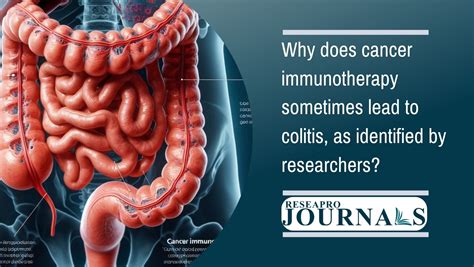 Cancer immunotherapy's immune activation may cause colitis—research ...