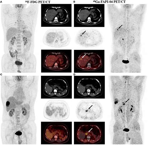 Frontiers FAPI PET CT In The Diagnosis Of Abdominal And Pelvic Tumors