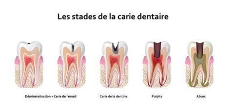 La carie dentaire tout ce que vous devez savoir Ilajak médical