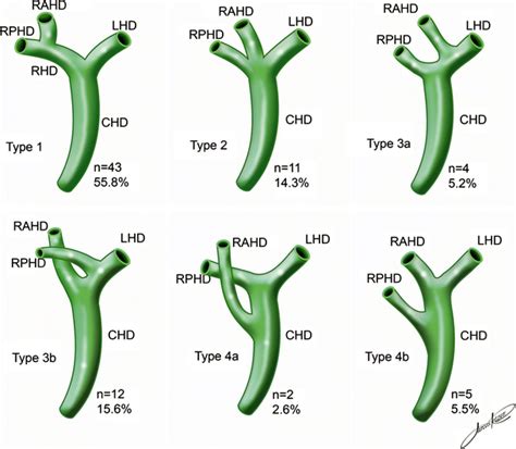 Bile Duct Confluence Anatomic Variations And Its Classification