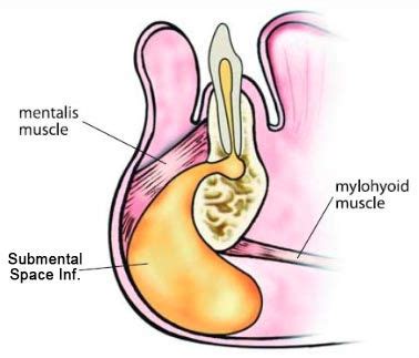 Head & Neck Space Infection