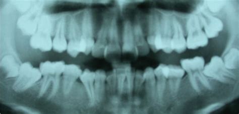 Es Necesario Quitar Las Muelas Del Juicio Para Poner Brackets