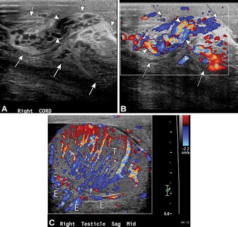 Pathologic Conditions At Imaging Of The Spermatic Cord Radiographics