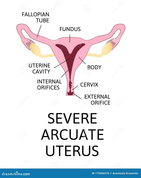 The Shape of the Uterus, the Female Reproductive Organ. Normal, Mild Arcuate, Moderate, Severe ...