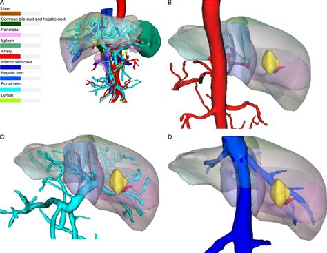 Precision Liver Resection Three Dimensional Reconstruction Combined