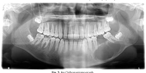 Adenomatoid Odontogenic Tumor