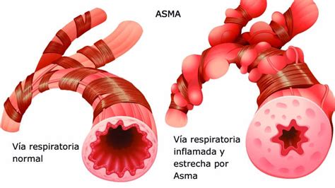 Tengo Una Crisis De Asma Qu Hago