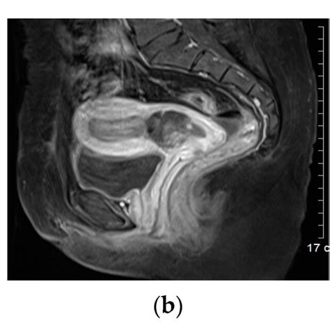 Transvaginal Ultrasound Doppler Image And Pelvic Mri Scan Of Cesarean Download Scientific