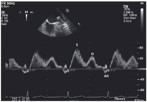 Left Atrial And Right Atrial Size Function And Pathology Thoracic Key