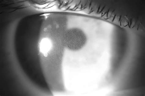 Severe Diffuse Lamellar Keratitis After Femtosecond Lamellar Keratectomy British Journal Of