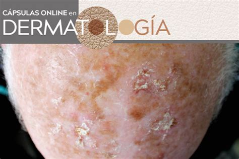 Cápsulas on line en dermatología Imágenes diagnósticas en Queratosis