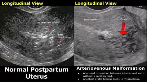 Abnormal Transvaginal Ultrasound 