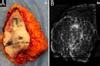 RBCP Modified Reduction Mammoplasty For Optimization Of Oncological