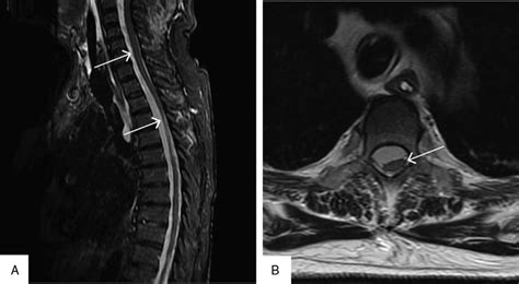 Epidural Hematoma Spine Mri