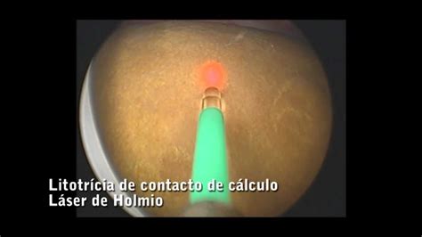 Litotricia De Contacto De Cálculo Láser De Holmio Youtube