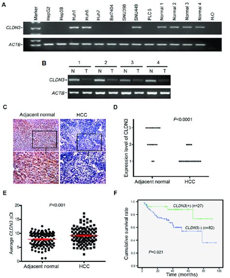 Downregulation Of Cldn3 In Hcc A Cldn3 Expression Was Frequently