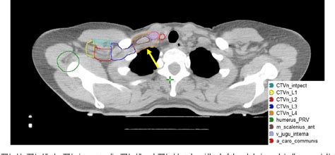 Figure 1 From ESTRO Consensus Guideline On Target Volume Delineation