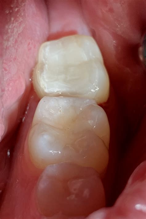 Tooth Colored Fillings | Dentist In Reston, VA | Reston Sunrise