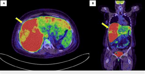 Figure 3 From Primary Hepatic Epithelioid Hemangioendothelioma