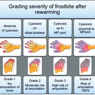 Grading severity of frostbite and bone amputation risk after rewarming ...