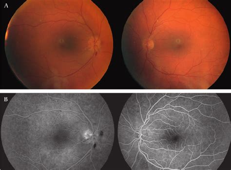 (A) Right ophthalmic fundus revealing a papillitis that was associated ...