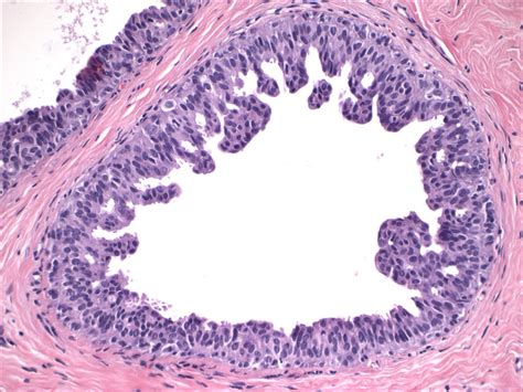 Pathology Outlines Usual Ductal Hyperplasia